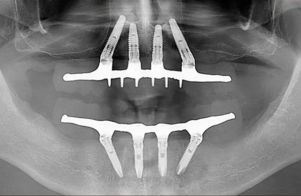 prodecimentos implante dentario cristian manenti all on four