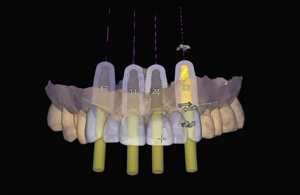prodecimentos implante dentario cristian manenti cirurgia guiada