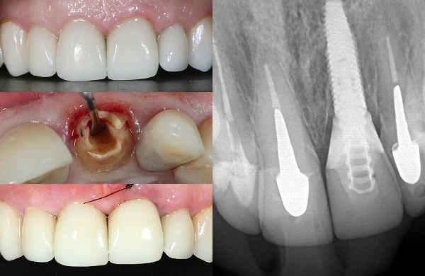 prodecimentos implante dentario cristian manenti implante carga imediata