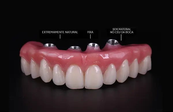 prodecimentos implante dentario cristian manenti protese protocolo