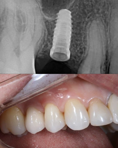 resultados cristian manenti 15